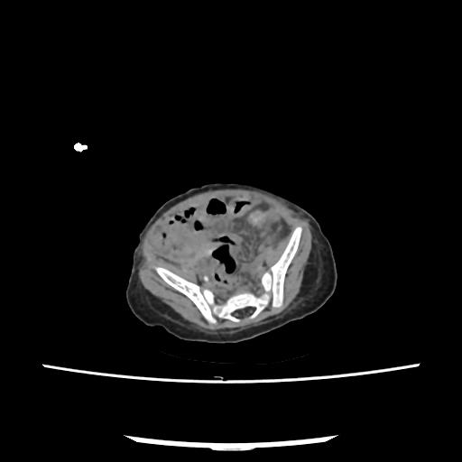 Caroli disease with autosomal recessive polycystic kidney disease (ARPKD) (Radiopaedia 89651-106703 E 193).jpg