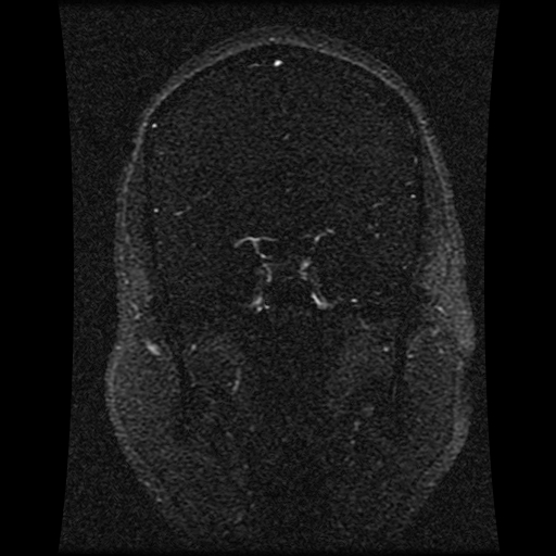 Carotid arterial dissection with acute cerebral infarction (Radiopaedia 26636-26784 MRV 105).jpg