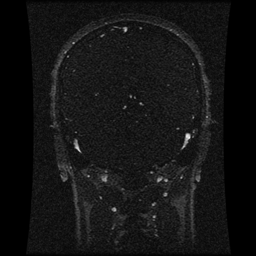 Carotid arterial dissection with acute cerebral infarction (Radiopaedia 26636-26784 MRV 78).jpg