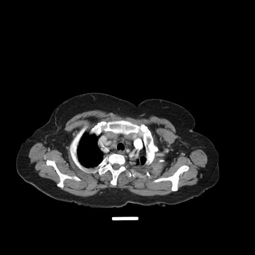 File:Carotid body tumor (Radiopaedia 21021-20948 B 26).jpg