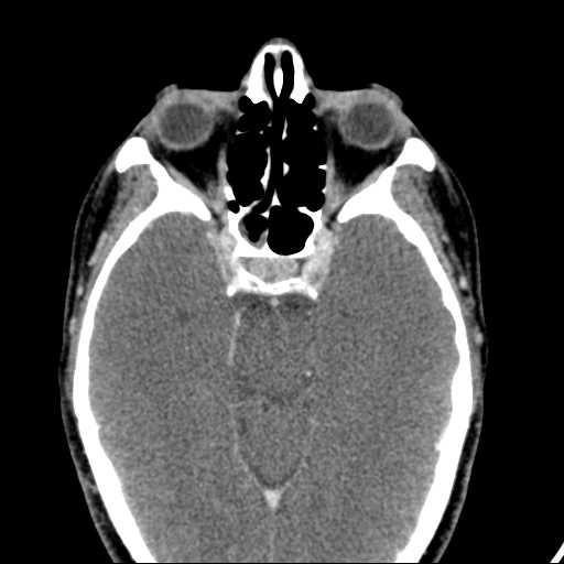 File:Carotid body tumor (Radiopaedia 60652).jpg