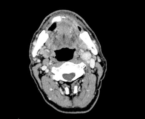 Carotid body tumor (Radiopaedia 61750-69757 Axial Post contrast 38).jpg