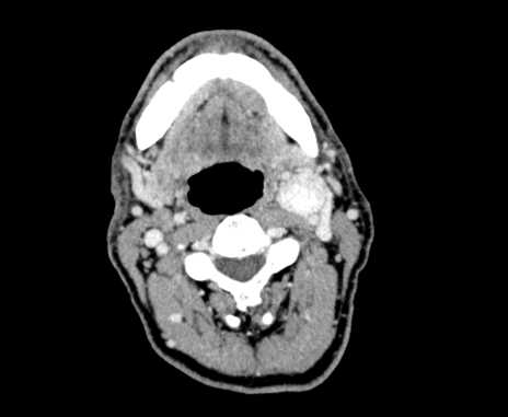 Carotid body tumor (Radiopaedia 61750-69757 Axial Post contrast 42).jpg