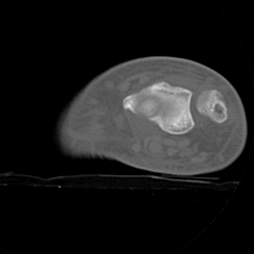 File:Carpo-metacarpal fracture-dislocations with hamatum split fracture (Radiopaedia 18482-18343 Axial bone window 29).jpg