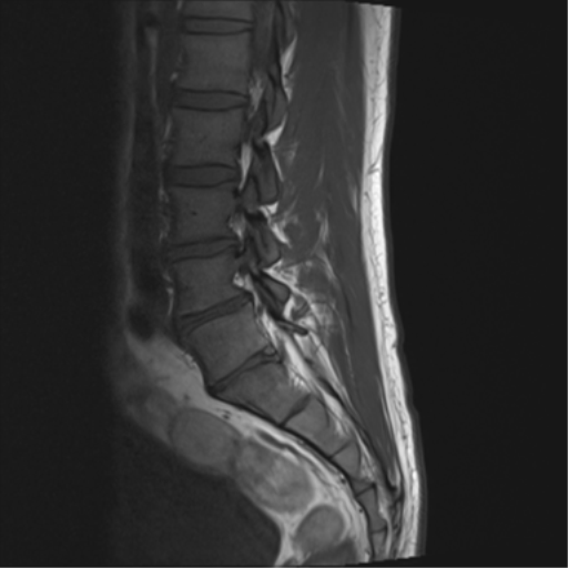 File:Cauda equina syndrome (Radiopaedia 53615-59672 Axial T1 11).png