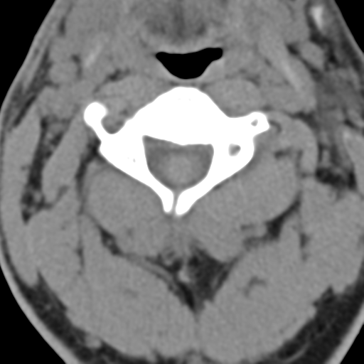 File:Cavernoma of cervical cord (Radiopaedia 50838-56346 Coronal non-contrast 5).png