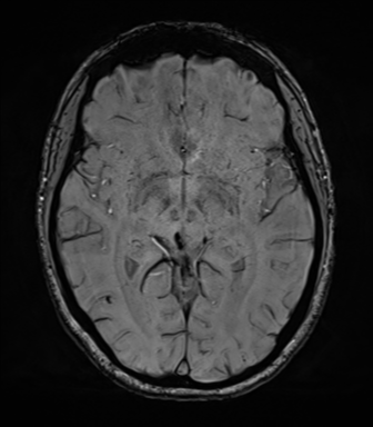 File:Cavernoma with bleed - midbrain (Radiopaedia 54546-60773 Axial SWI 23).png