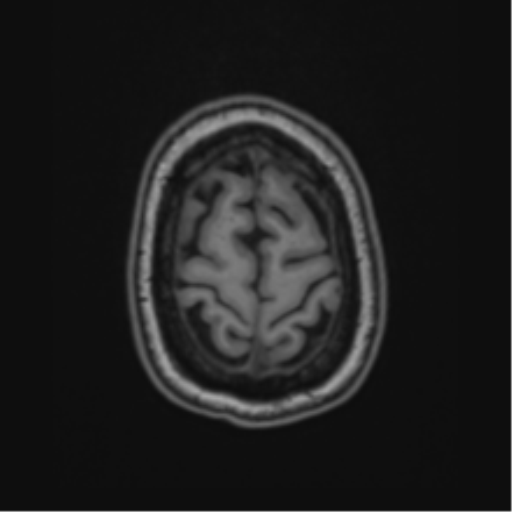 Cavernoma with bleed - midbrain (Radiopaedia 54546-60774 Axial T1 51).png