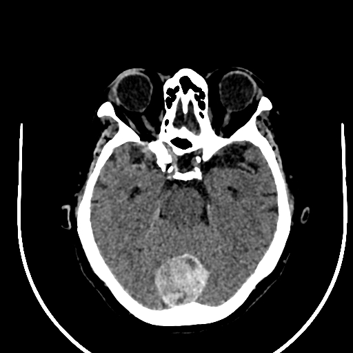 Cavernous hemangioma of the cerebellar falx (Radiopaedia 73025-83723 Axial non-contrast 49).jpg