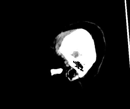 Cavernous hemangioma of the cerebellar falx (Radiopaedia 73025-83723 B 26).jpg