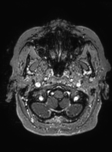 Cavernous hemangioma of the cerebellar falx (Radiopaedia 73025-83724 Axial T1 C+ 311).jpg