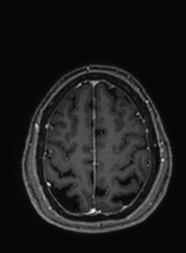 Cavernous hemangioma of the cerebellar falx (Radiopaedia 73025-83724 Axial T1 C+ 71).jpg