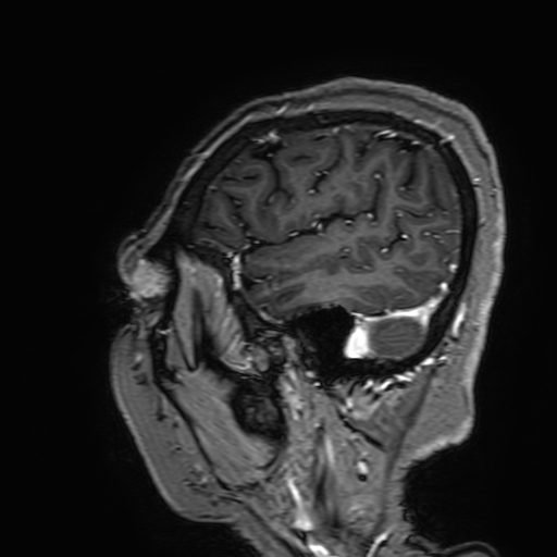 Cavernous hemangioma of the cerebellar falx (Radiopaedia 73025-83724 Sagittal T1 C+ 177).jpg