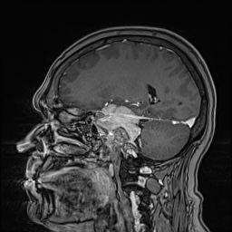 Cavernous sinus meningioma (Radiopaedia 63682-72367 Sagittal T1 C+ 74).jpg