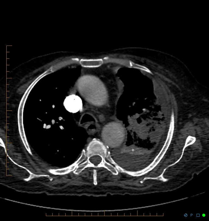 Cavitating pulmonary infarction (Radiopaedia 54634-60849 Axial C+ CTPA 19).jpg
