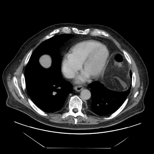 Cecal adenocarcinoma (Radiopaedia 64871-73817 A 3).jpg
