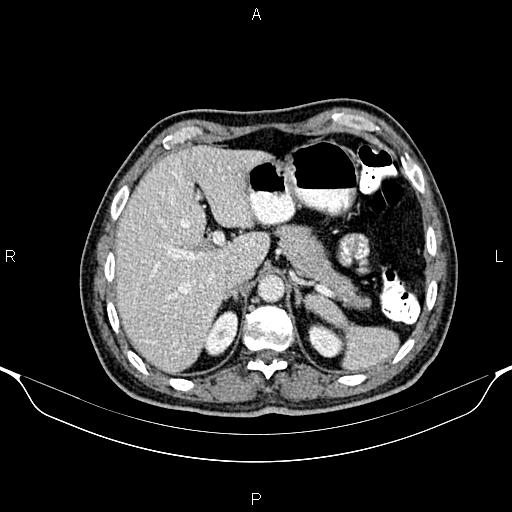 Cecal adenocarcinoma (Radiopaedia 85324-100916 B 21).jpg
