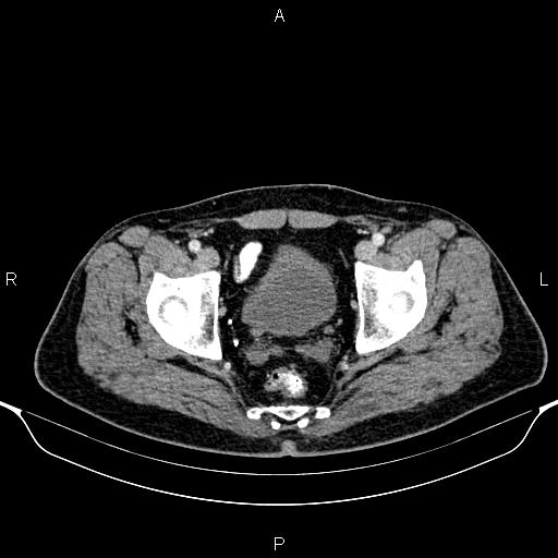 Cecal adenocarcinoma (Radiopaedia 85324-100916 B 91).jpg