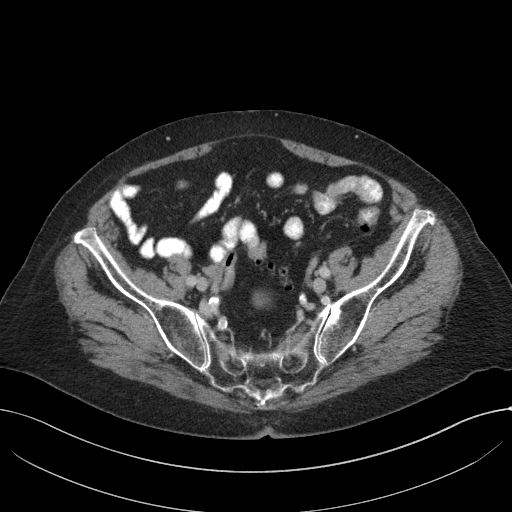 Cecal adenocarcinoma - surgical scar recurrence (Radiopaedia 79988-93264 C 56).jpg