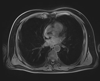 Cecal mass causing appendicitis (Radiopaedia 59207-66532 Axial T1 5).jpg
