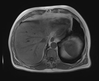 Cecal mass causing appendicitis (Radiopaedia 59207-66532 Axial T1 in-phase 27).jpg