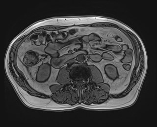Cecal mass causing appendicitis (Radiopaedia 59207-66532 D 72).jpg