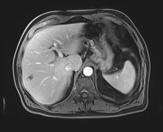 Cecal mass causing appendicitis (Radiopaedia 59207-66532 T1 C+ PV phase 35).jpg