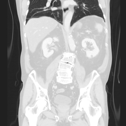 Cecal volvulus (Radiopaedia 75378-86620 Coronal lung window 88).jpg