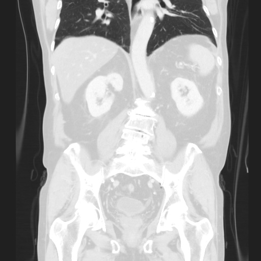 Cecal volvulus (Radiopaedia 75378-86620 Coronal lung window 91).jpg
