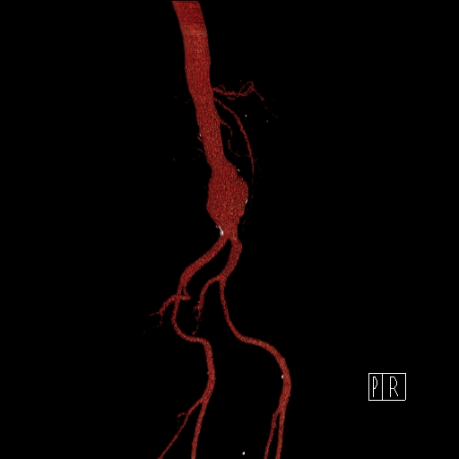 File:Celiac artery compression by the diaphragmatic crurae (Radiopaedia 31739-32666 3D CTA 7).jpg