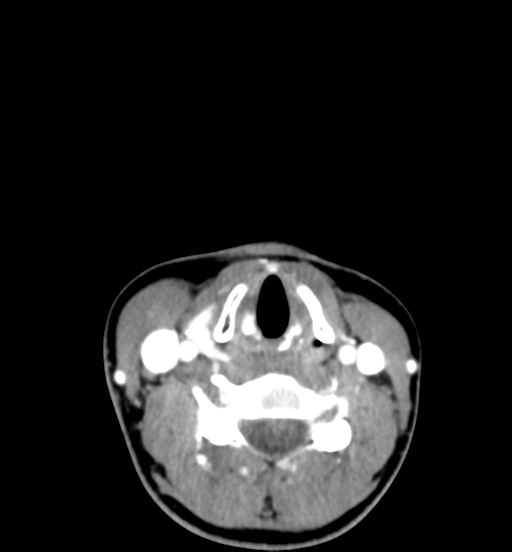 File:Cemento-ossifying fibroma (Radiopaedia 46243-50643 Axial C+ delayed 54).png