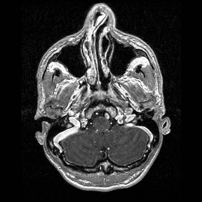 Central-variant posterior reversible encephalopathy syndrome (PRES) (Radiopaedia 43880-47358 Axial T1 C+ 15).jpg
