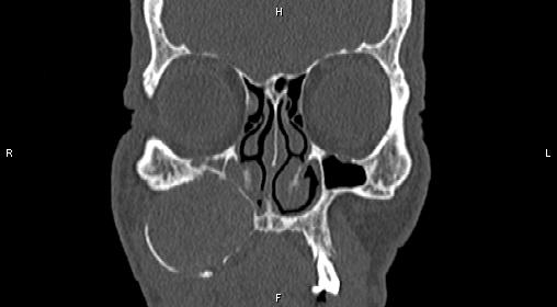 File:Central giant cell granuloma (Radiopaedia 83346-97761 Coronal bone window 9).jpg