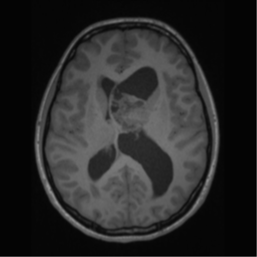 File:Central neurocytoma (Radiopaedia 37664-39557 Axial T1 41).png