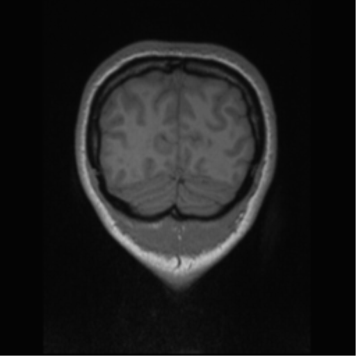 Central neurocytoma (Radiopaedia 37664-39557 Coronal T1 12).png