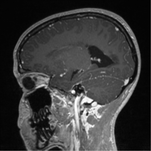 File:Central neurocytoma (Radiopaedia 37664-39557 Sagittal T1 C+ 64).png