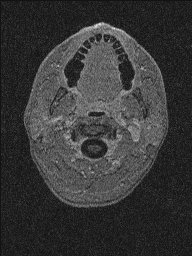 Central neurocytoma (Radiopaedia 56690-63469 Axial T1 C+ 174).jpg