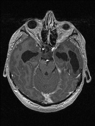 Central neurocytoma (Radiopaedia 56690-63469 Axial T1 C+ 54).jpg
