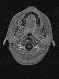 Central neurocytoma (Radiopaedia 56690-63469 Axial T1 C+ 7).jpg