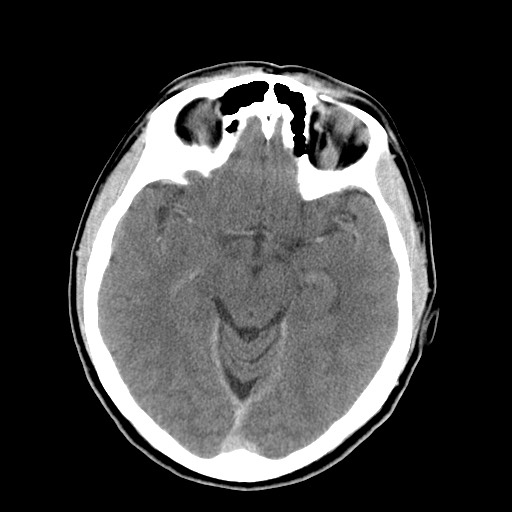 Central neurocytoma (Radiopaedia 68725-78432 Axial C+ 28).jpg