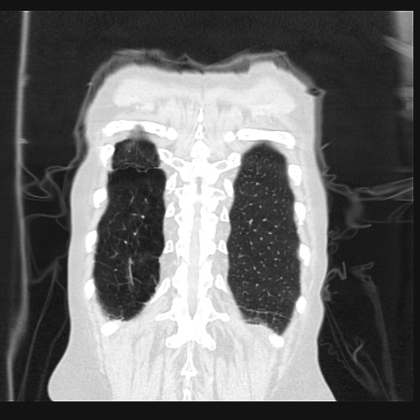 Centrilobular pulmonary emphysema (Radiopaedia 24495-24789 Coronal lung window 69).jpg