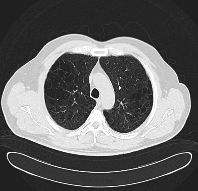 Centrilobular pulmonary emphysema (Radiopaedia 26808-26971 C 12).jpg
