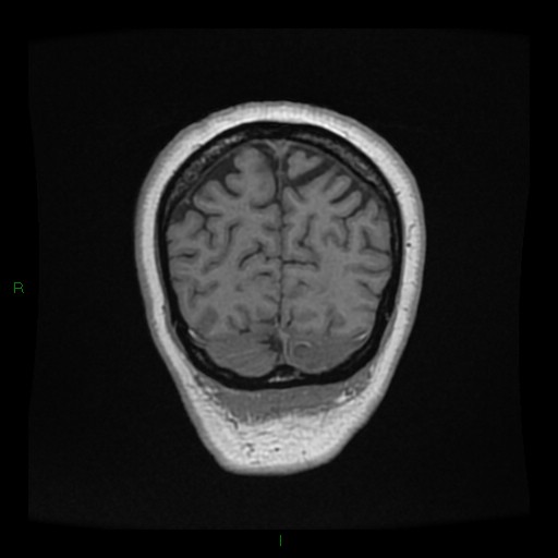 Cerebellar abscess (Radiopaedia 78135-90678 Coronal T1 C+ 145).jpg