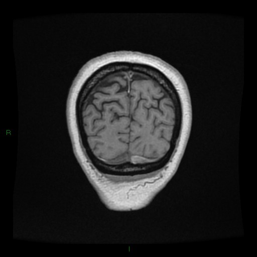 Cerebellar abscess (Radiopaedia 78135-90678 Coronal T1 C+ 153).jpg