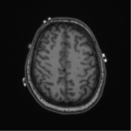 Cerebellar hemangioblastomas and pituitary adenoma (Radiopaedia 85490-101176 Axial T1 56).png