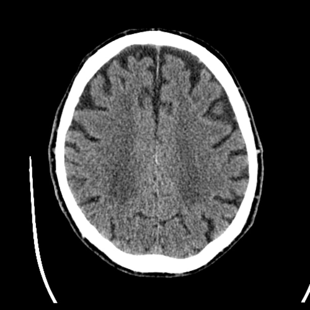 Cerebellar hemorrhage (Radiopaedia 27193-27359 Axial non-contrast 36).jpg