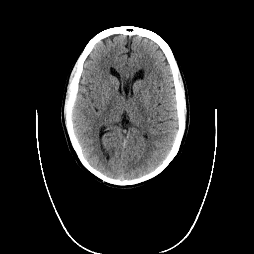 File:Cerebellar infarct due to vertebral artery dissection with posterior fossa decompression (Radiopaedia 82779-97031 Coronal non-contrast 1).png