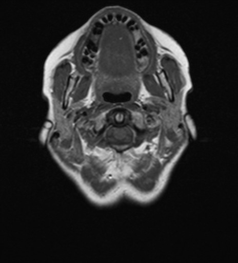 File:Cerebellar metastases (Radiopaedia 24038-24249 Axial T1 18).jpg