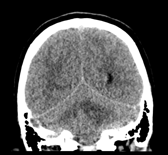 File:Cerebellar metastases - colorectal adenocarcinoma (Radiopaedia 40947-43652 Coronal non-contrast 69).png