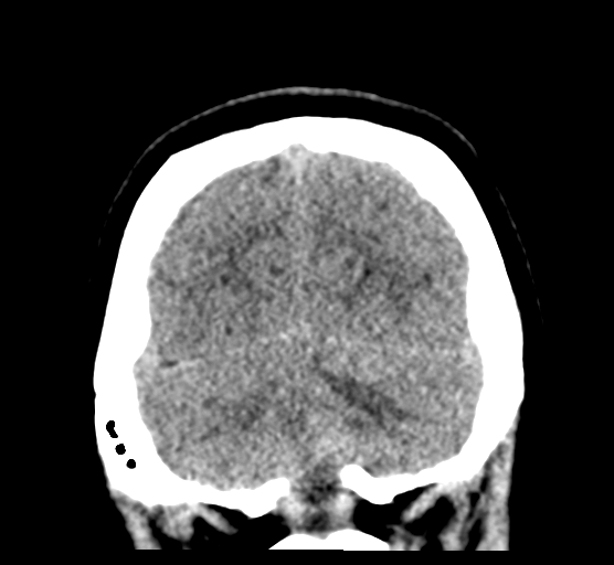 Cerebellar metastases - colorectal adenocarcinoma (Radiopaedia 40947-43652 Coronal non-contrast 79).png